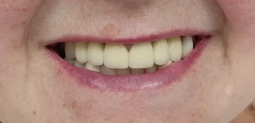 Восстановление фронтальных зубов фото после