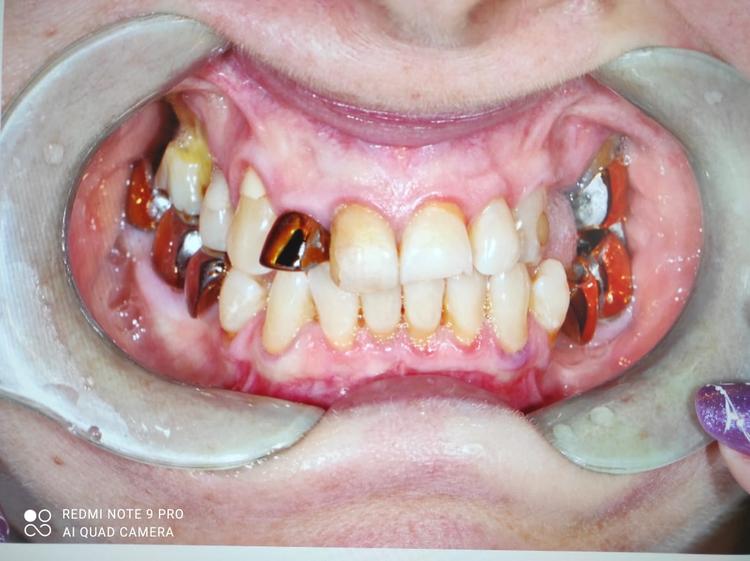 Восстановление фронтальных зубов фото до
