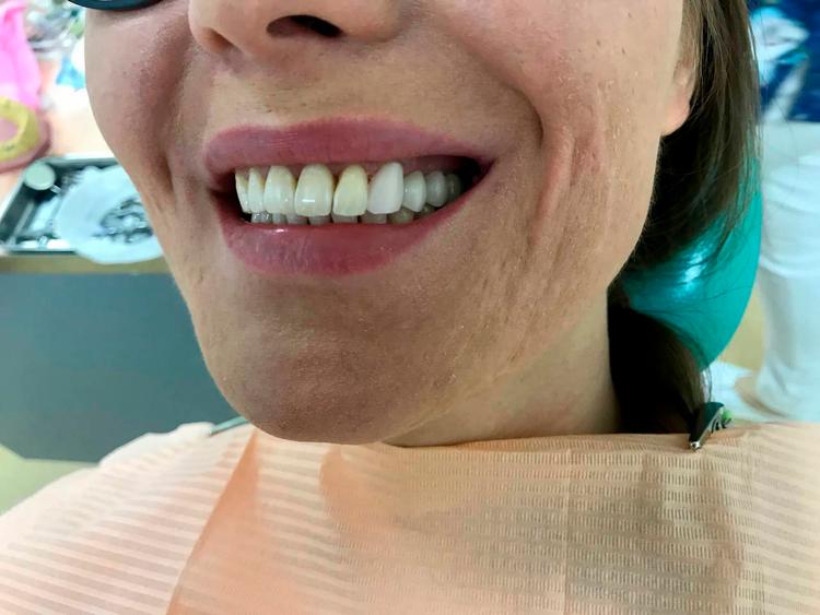 Восстановление отсутствующих зубов в зоне улыбки фото после