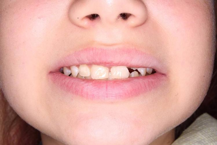 Восстановление зуба в зоне улыбке фото до