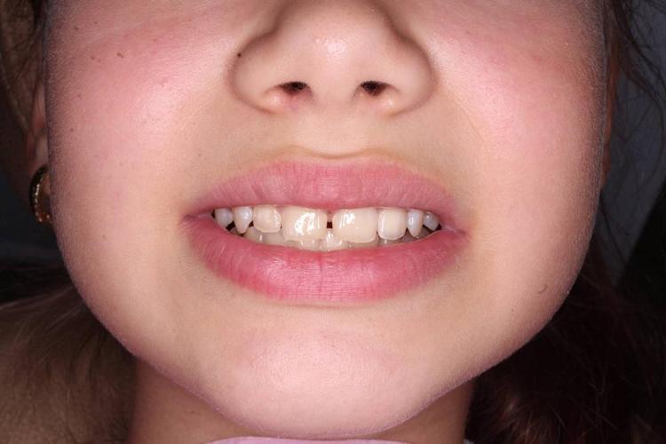 Восстановление зуба в зоне улыбке фото после