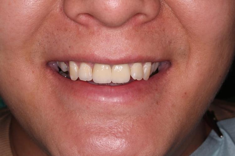Восстановление зубов в зоне улыбке фото после
