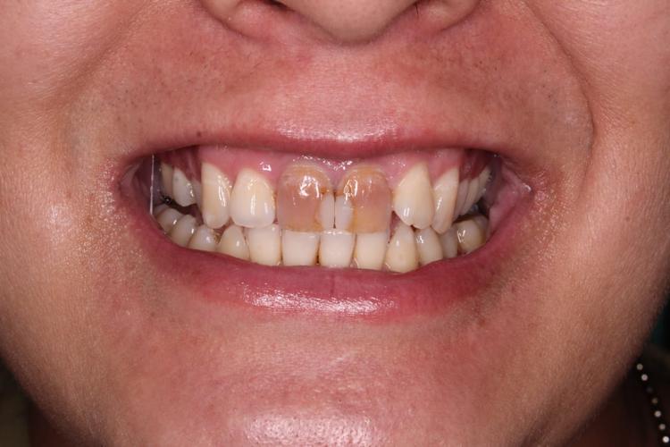 Восстановление зубов в зоне улыбке фото до