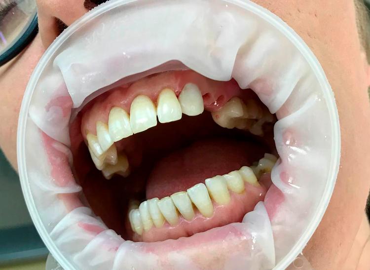 Восстановление отсутствующих зубов в зоне улыбки фото до