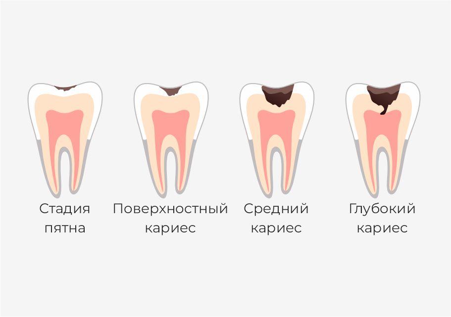 Стадии кариеса