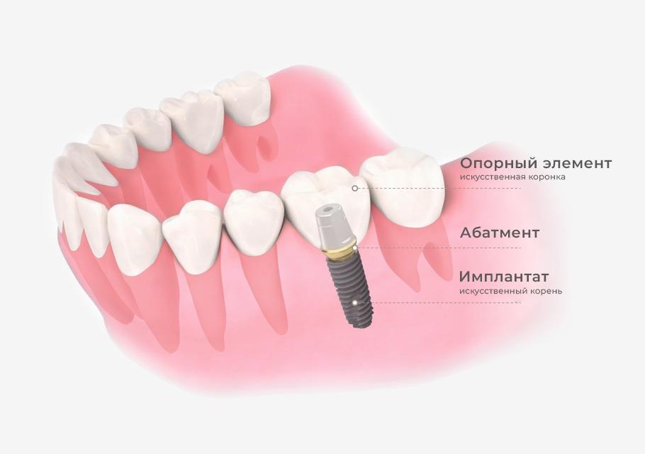 Как устроен "Искусственный зуб"