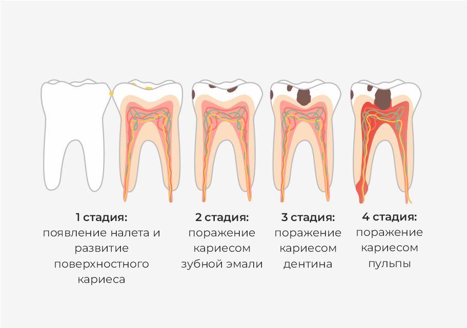 Стадии развития пульпита