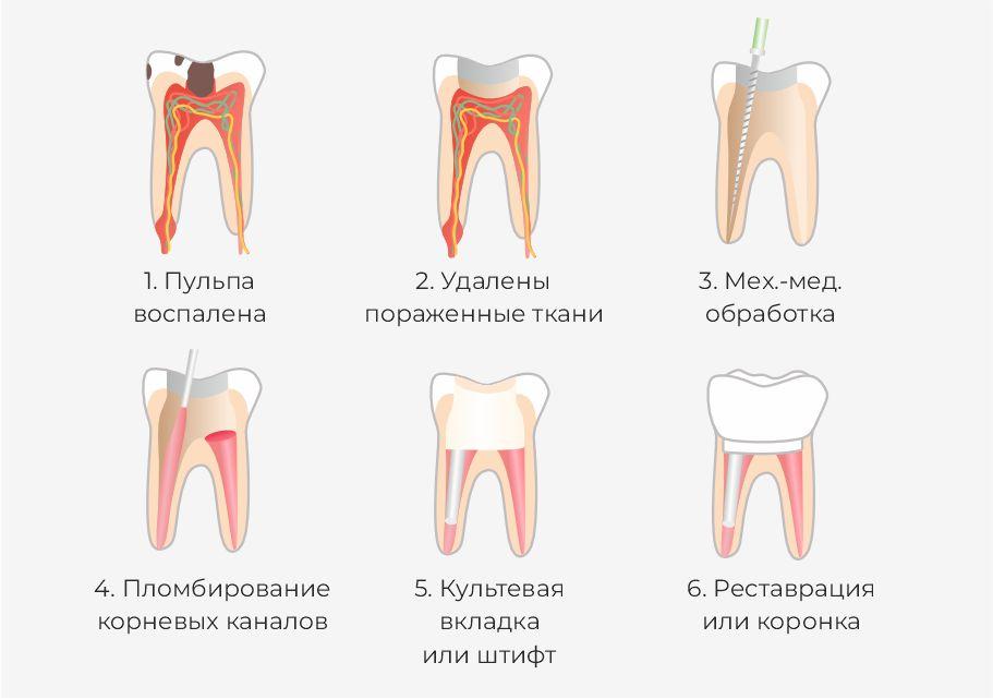 Этапы лечения пульпита