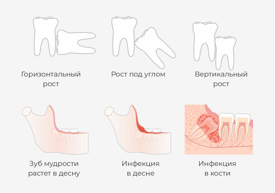 Проблемы при прорезывании зуба мудрости