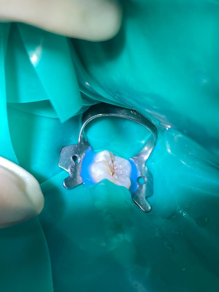 Лечение кариеса постоянного зуба у ребенка фото до