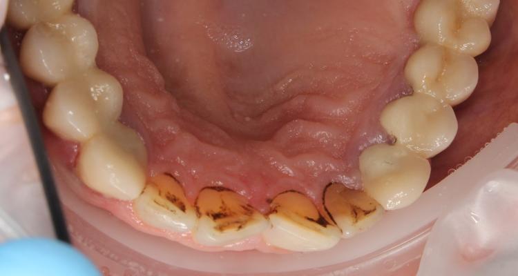 Профессиональная гигиена верхней фронтальной группы зубов фото до