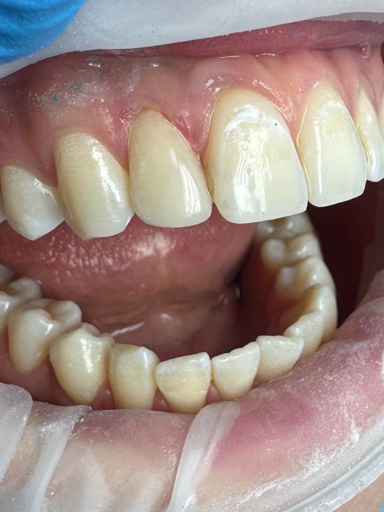 Эстетическая реставрация зуба фото после