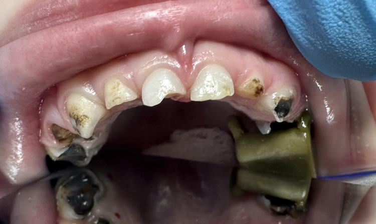 Лечение в условиях наркоза фото до