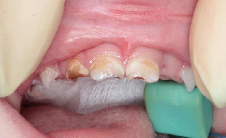 Циркониевые коронки в условиях наркоза фото до