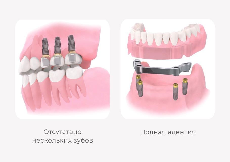 Имплантаты Osstem при отсутствии нескольких зубов