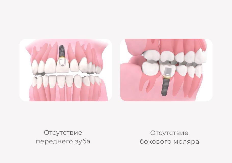 Имплантат Osstem при отсутствии одного зуба