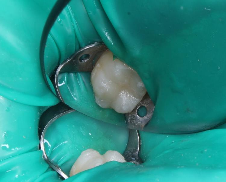 Лечение кариеса фото после