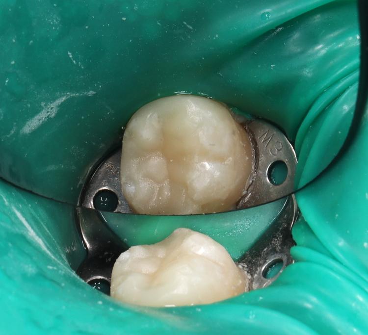 Лечение кариеса фото после