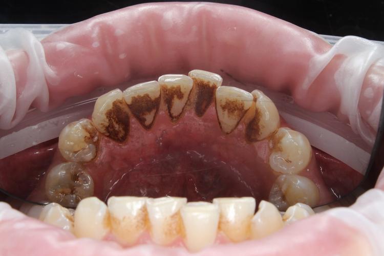 Профессиональная гигиена полости рта фото до