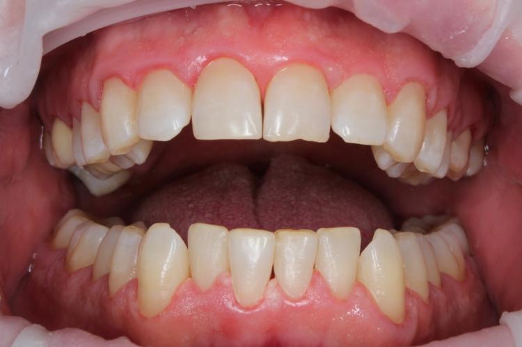 Профессиональная гигиена полости рта фото после