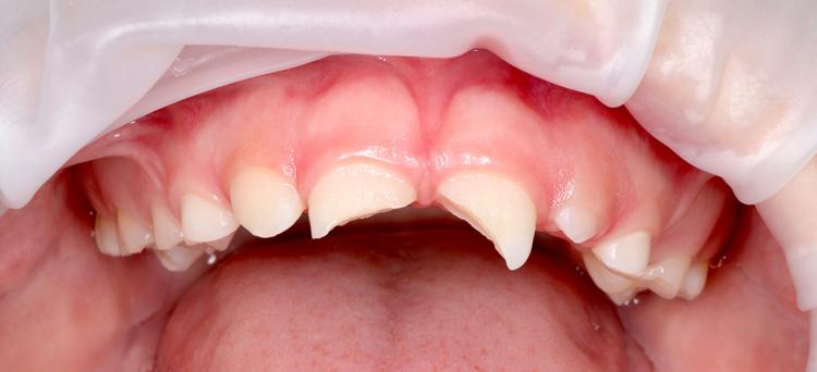 Восстановление передних зубов фото до